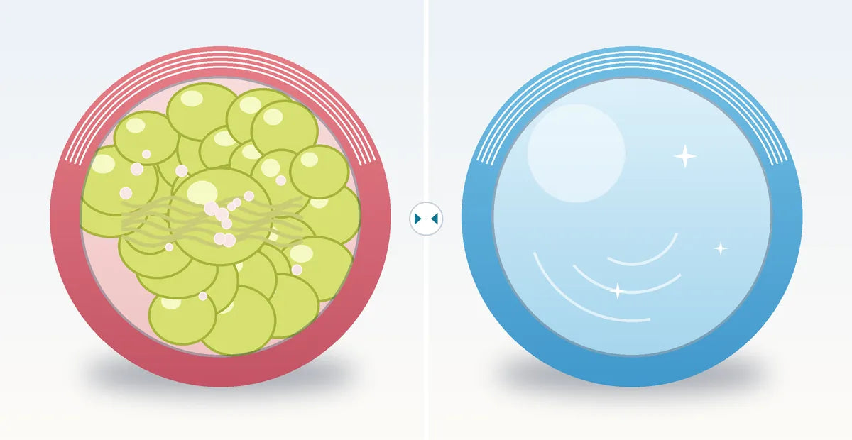 Ilustración comparativa: vía respiratoria con mucosidad espesa y vía despejada